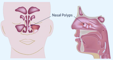 Nasal Polyps and Treatment - Fort Worth ENT & Sinus